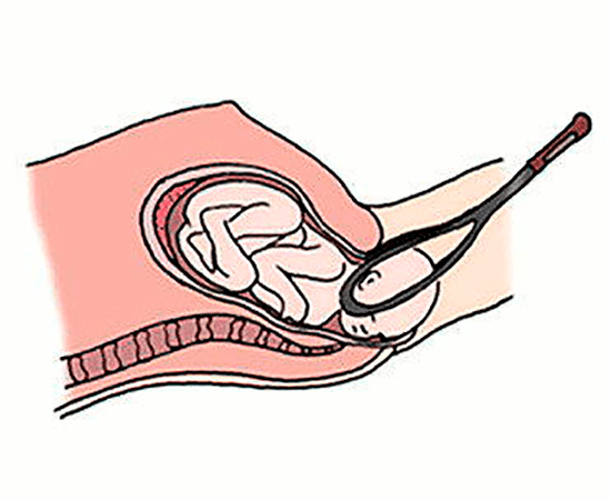 Акушерские щипцы