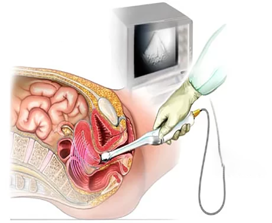 УЗИ органов малого таза