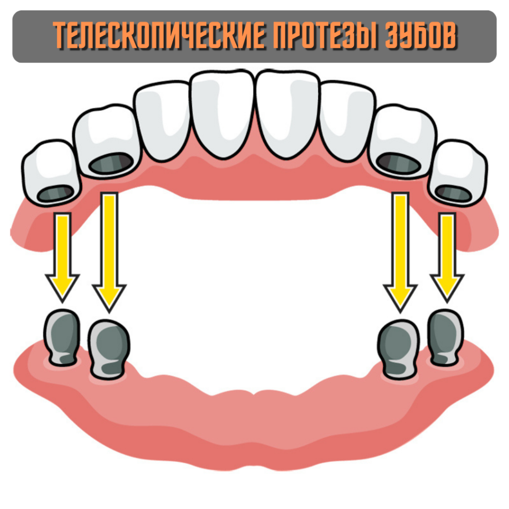 Телескопические протезы